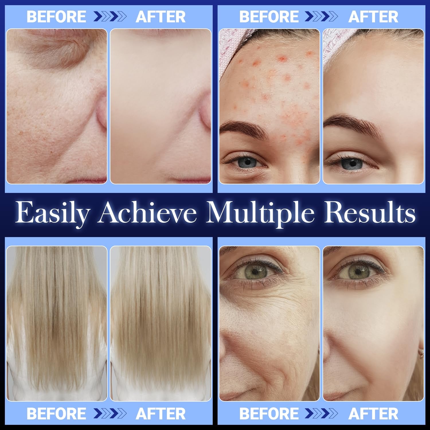 Transform Your Skin at Home with the High Frequency Facial Wand - Portable Handheld Blue Skin Care Device with 4 Glass Tubes